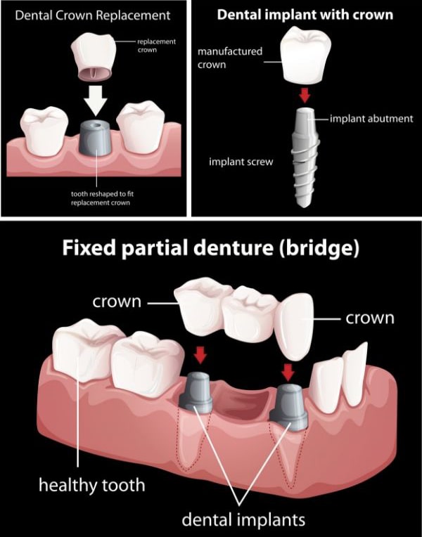 uses of dental crowns