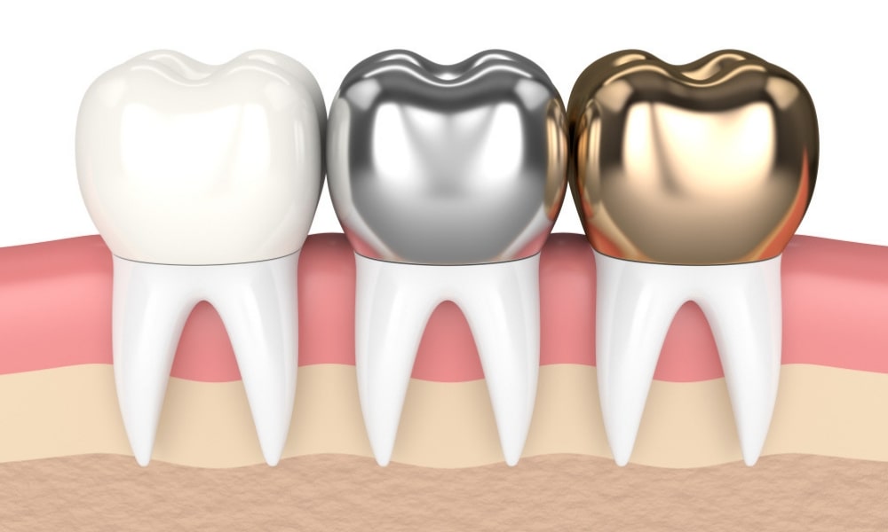 Qué son las coronas dentales?