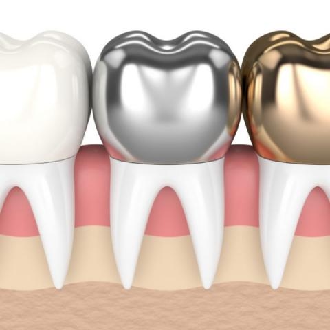 how long do dental crowns usually last