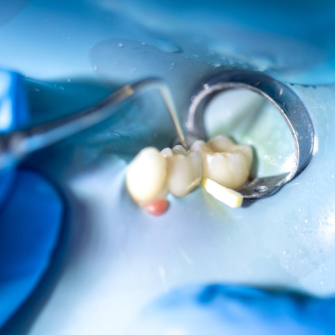 steel dental crown