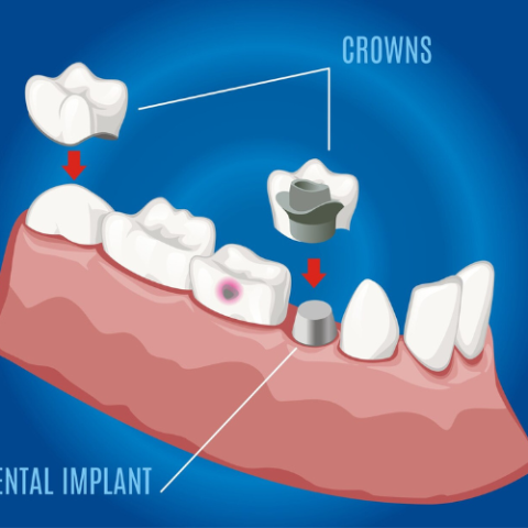 zirconia dental crown