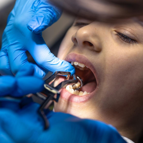 stainless steel crowns with white facings