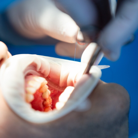 ¿Cuánto duran los implantes dentales?